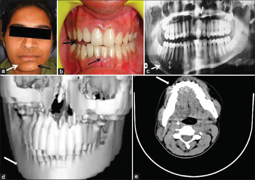 Case 2. 18-year-old girl with asymmetry of the face due to hemimandibularr hypertrophy hybrid.variant. (a) Photograph of the face shows enlargement of mandible on the right side. (white arrow) with deviation of chin to the left. (black arrow). (b) Intra-oral view reveals open bite. (thick arrow). Mandibular central incisor midline does not coincide with facial midline. (thin arrow). (c) Panoramic radiograph demonstrates elongation (arrow) and increased distance between the mandibular molar roots and inferior alveolar nerve canal on the right side (double-headed arrow). (d) Three-dimensional computed tomography (CT) shows elongation and enlargement of the mandible on the right side (arrow). (e) CT axial view reveals asymmetry due to increased growth of the mandible on the right side (arrow).